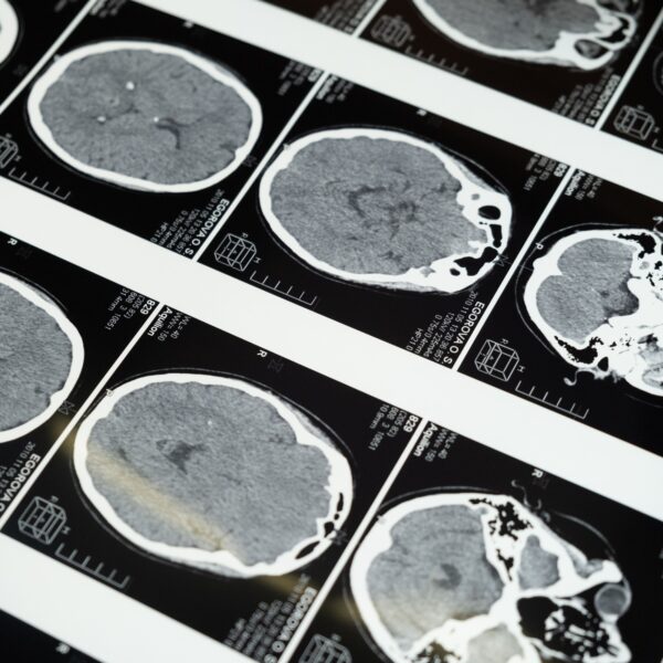 Could Magnetic Brain Stimulation Be the Missing Piece in Your Health Journey?